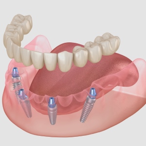 All On 4 Dental Implants in Santa Ana, CA
