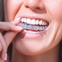 Clear Aligners in Santa Ana, CA