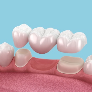 Dental Bridges in Santa Ana, CA
