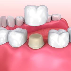 Dental Crowns in Santa Ana, CA