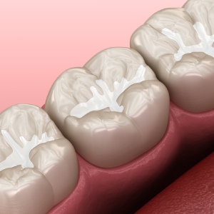 Dental Fillings in Santa Ana, CA