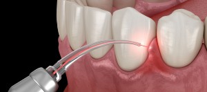 Gum Disease Laser Therapy in Santa Ana CA Gum Disease Laser Therapy in Santa Ana CA