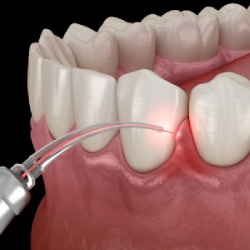 Gum Disease Laser Therapy in Santa Ana, CA
