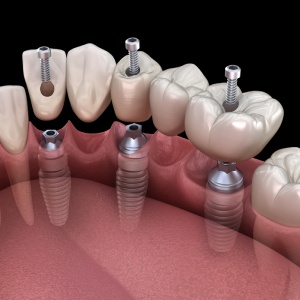 Implant Retained Dentures in Santa Ana, CA