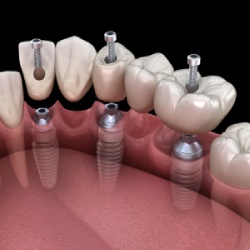 Implant Retained Dentures in Santa Ana, CA