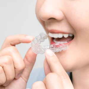 Invisalign in Santa Ana, CA