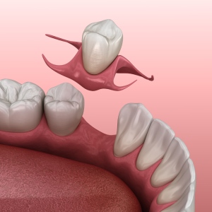 Partial Dentures in Santa Ana, CA