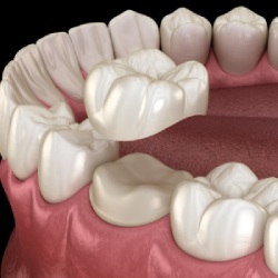 Same Day Crowns in Santa Ana, CA
