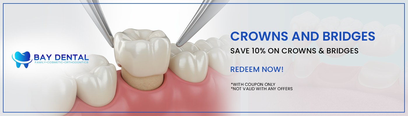 At Bay Dental, Dr. Linda Pearce, DDS provides customized dental crown treatments to help protect and restore damaged teeth. Our approach focuses on creating solutions that support tooth function, appearance, and lasting oral health. For more information, contact us or request an appointment online. We are conveniently located at 3620 S. Bristol St, #307, Santa Ana, CA.