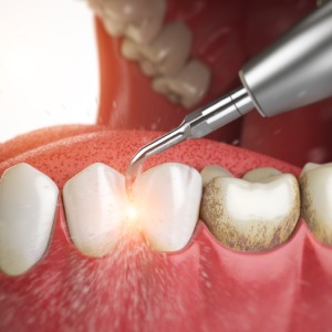 Periodontal Maintenance in Santa Ana, CA