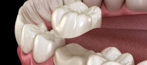 Same Day Crowns in Santa Ana CA Same Day Crowns in Santa Ana CA